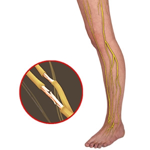 Understanding Nerve Damage: Diagnoses and Treatment Options